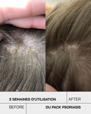 Routine Psoriasis Control S - Touché Skincare Lab