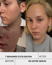 Acide Salicylique - Touché Skincare Lab