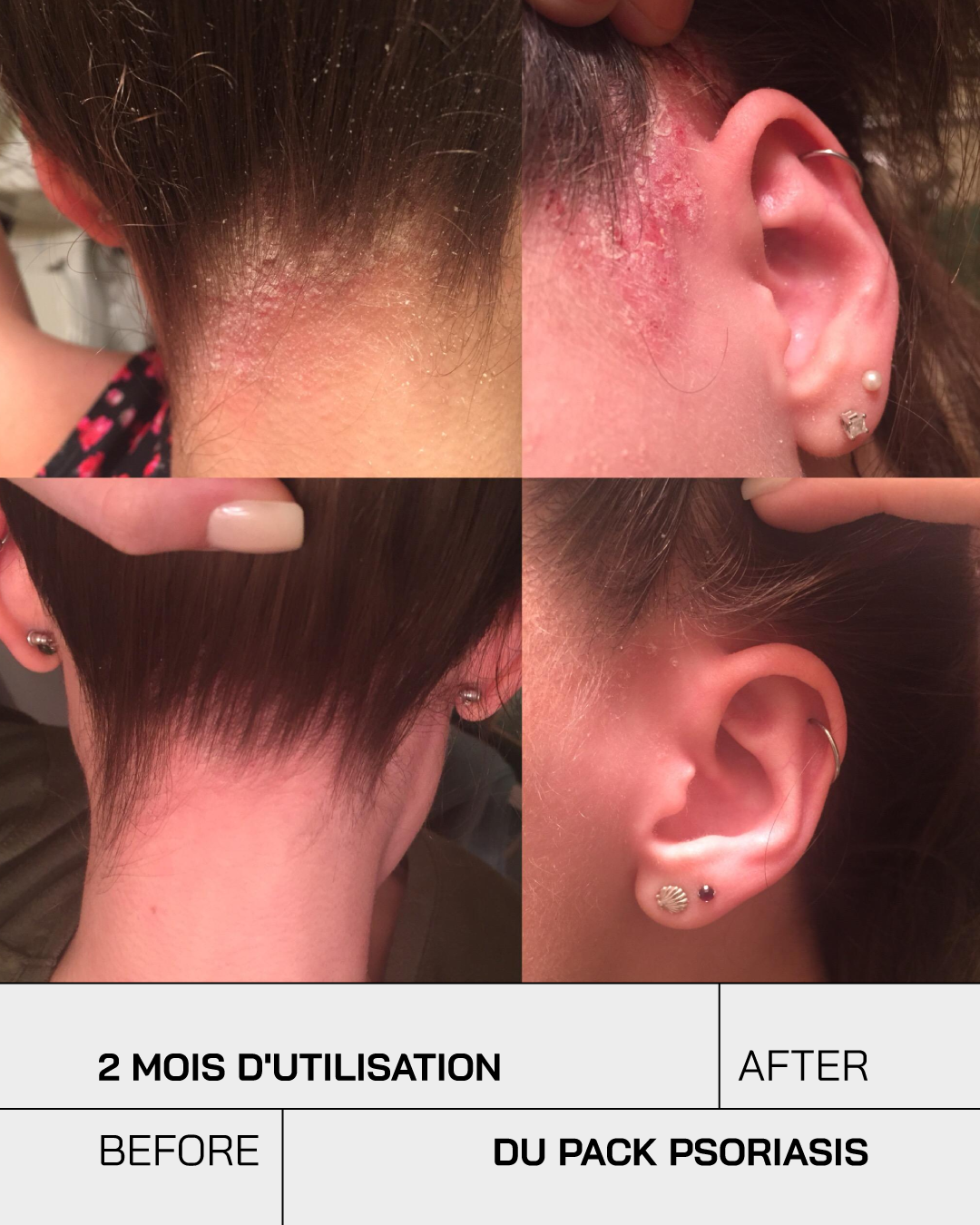 Routine Psoriasis Control - Touché Skincare Lab