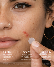 Micro-Dart Pimple Patches