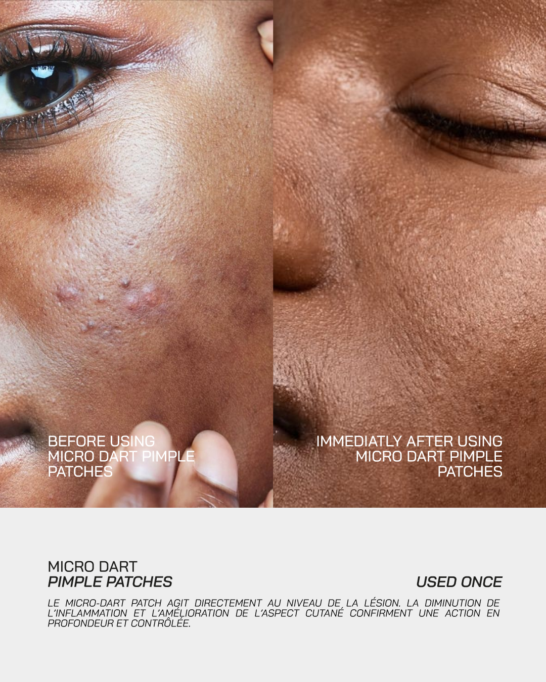 Micro-Dart Pimple Patches