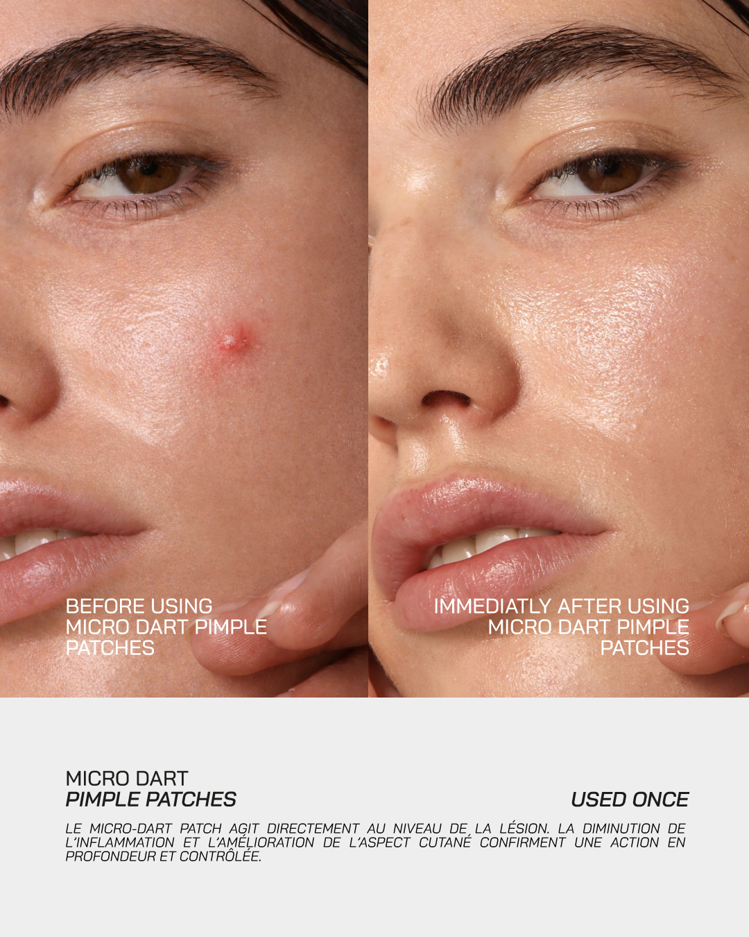 Micro-Dart Pimple Patches