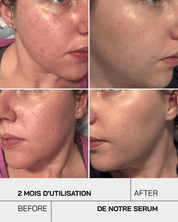 Acide Salicylique - Touché Skincare Lab