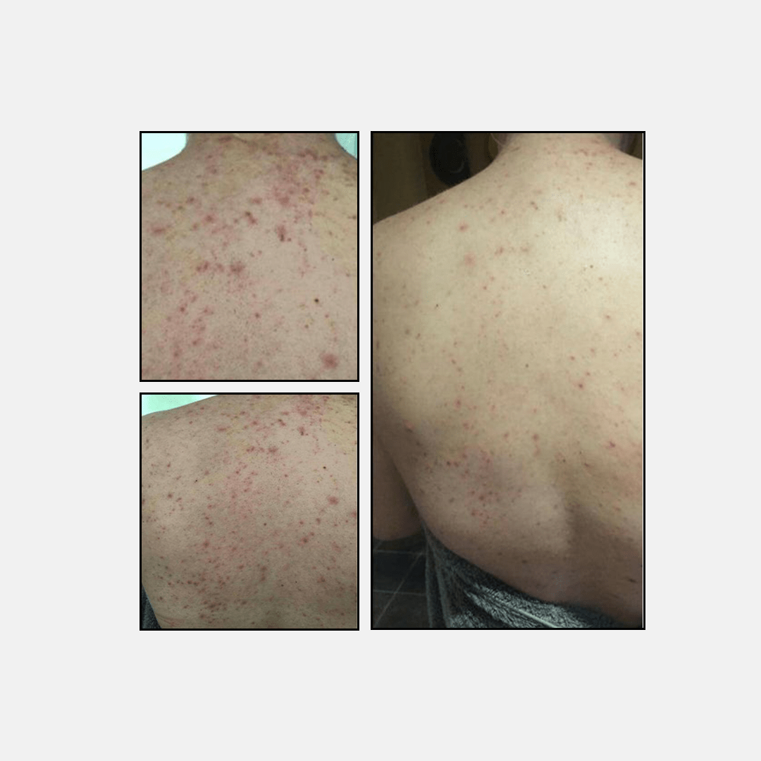 Anti-imperfections leads - Touché Skincare Lab