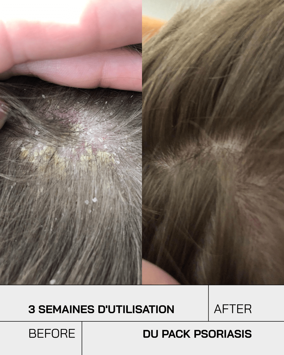 Routine Psoriasis Control - Touché Skincare Lab