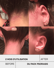 Routine Psoriasis Control Junior - Touché Skincare Lab