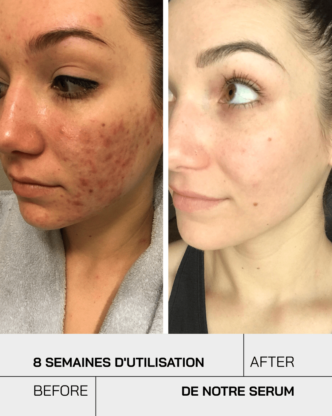 Anti Acné - Touché Skincare Lab