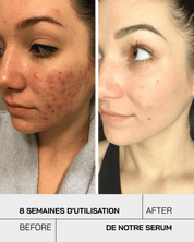 Anti Acné - Touché Skincare Lab