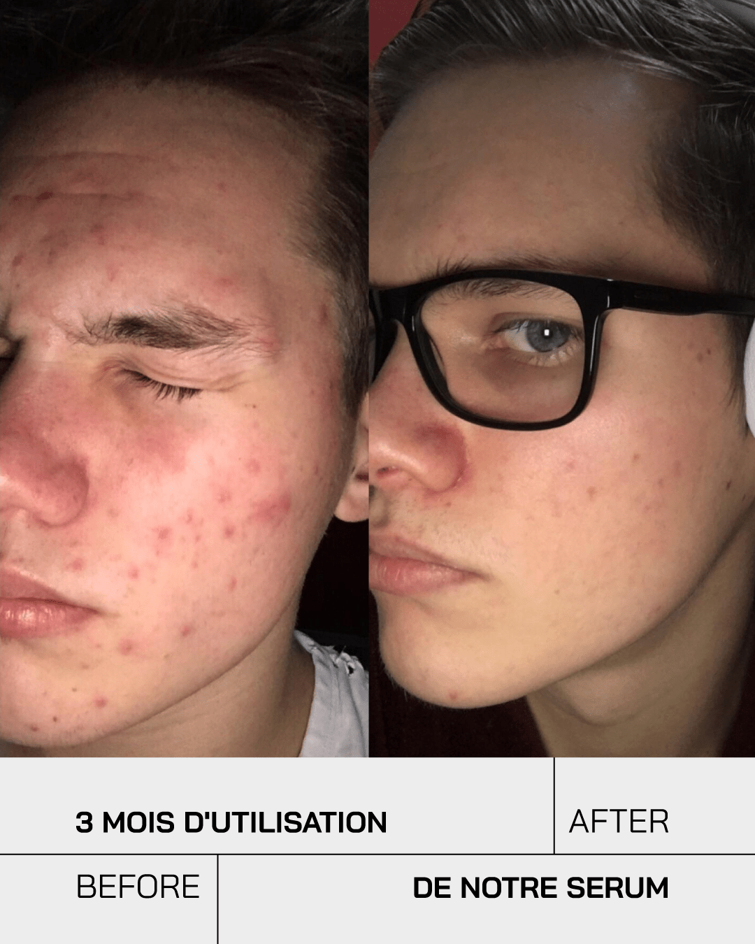 Anti Acné - Touché Skincare Lab