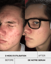 Anti Acné - Touché Skincare Lab