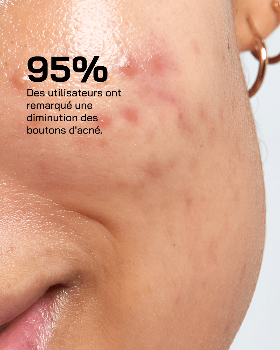 Anti Acné - Touché Skincare Lab