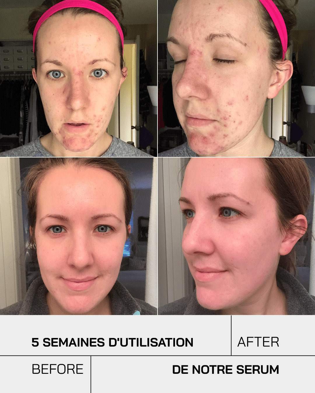 Anti Acné - Touché Skincare Lab