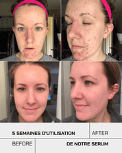 Anti Acné - Touché Skincare Lab