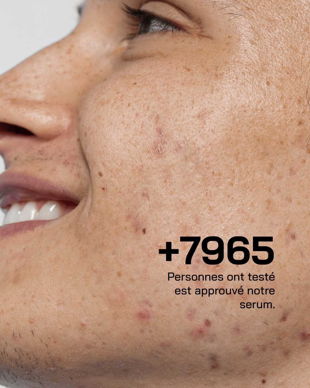 Anti Acné - Touché Skincare Lab